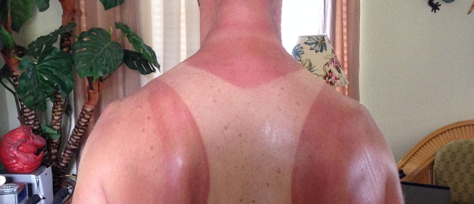 Use Sunblock
